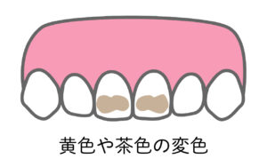 エナメル質形成不全_黄色や茶色の歯の変色