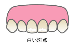 ホワイトスポット_白い斑点